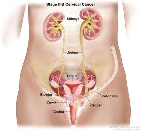 Cervical Cancer Treatment (PDQ®) - NCI