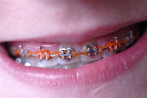 Everything You Need to Know About Elastics for Braces - Orthodontic Associates