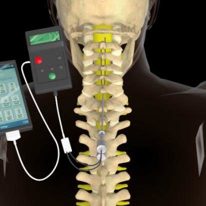 Dorsal column stimulator vs spinal cord stimulator - lityservers