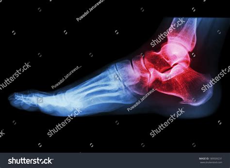 X-Ray Human'S Ankle With Arthritis Stock Photo 189509231 : Shutterstock