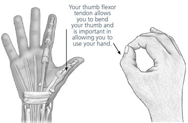 Advice and exercises following your thumb flexor tendon repair - South Tees Hospitals NHS ...