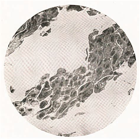 Figure 4 from On the Histology of Hydatidiform Mole in Its Relation to ...