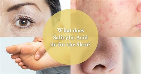 Salicylic Acid: Learn All About The Benefits For The Skin