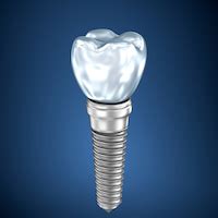 I am Titanium— Interesting Facts About Your Dental Implants - PA Dental Implants