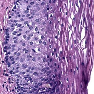 Examination results of patient M., 33 years: a -cells with atypia... | Download Scientific Diagram