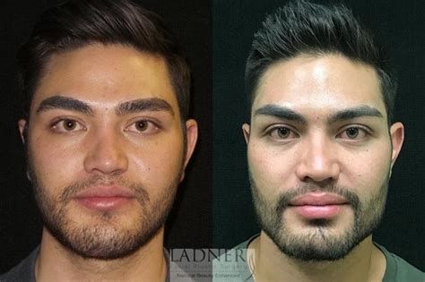 Facial Plastic Surgery for Men Before and After Photo Gallery | Denver, CO | Ladner Facial ...