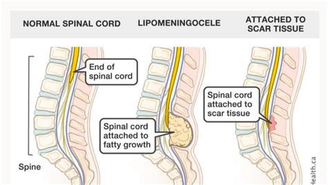 Fundraiser by The Wright Family : Jamie's emergency Tethered Spinal ...