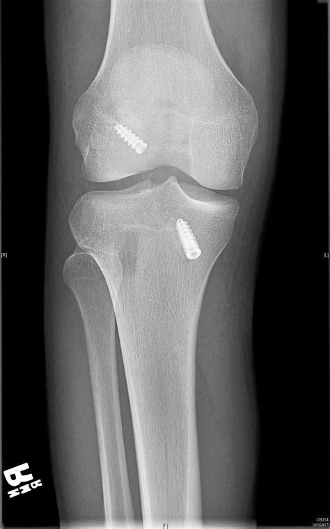 Knee X Ray After Acl Surgery - Corben Hanson