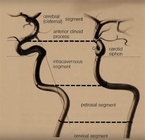 Internal Carotid Artery