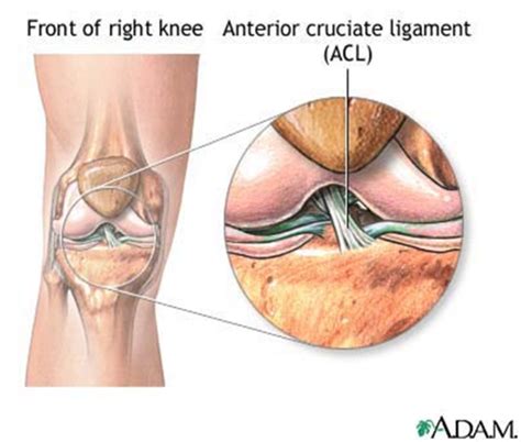 ACL Tear | Brisbane Knee and Shoulder Clinic | Dr Kelly ...