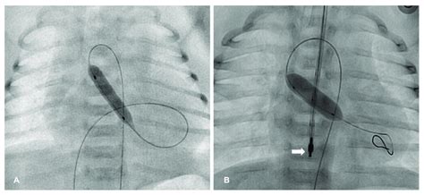 Balloon aortic valvuloplasty. (A) The valvuloplasty is performed with ...