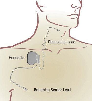 Sleep Apnea Implant – Sleeplay