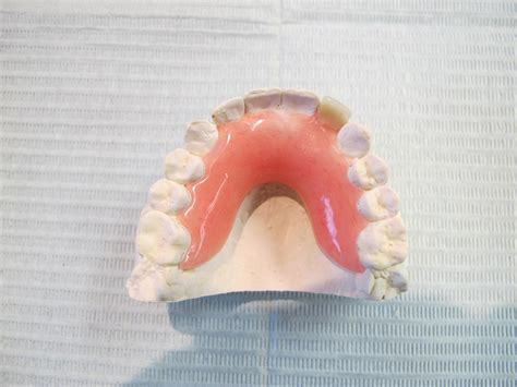 Partial Dentures in Windsor | Baker Lanoue Denture Clinic