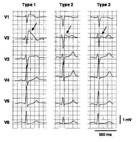 Frequently asked questions about Brugada's Syndrome | Vinmec