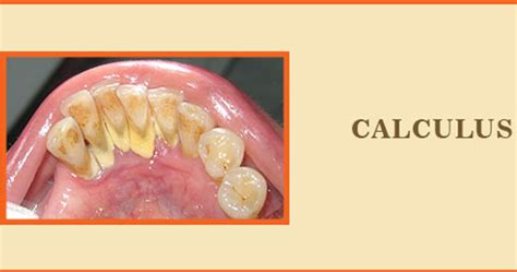 Calculus - Symptoms, Causes, Treatment