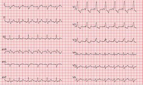 [Cardio-FR] Atrial flutter with 2:1 conduction and RBBB.