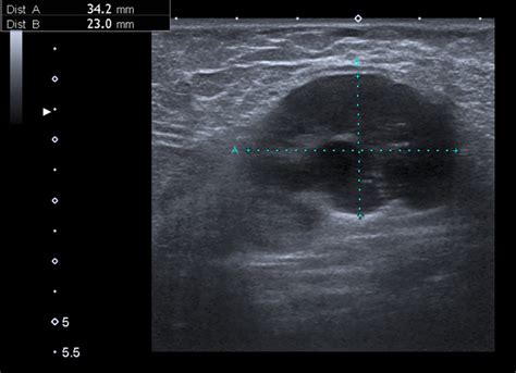 Ultrasound image of enlarged lymph node in the left axilla | Download Scientific Diagram