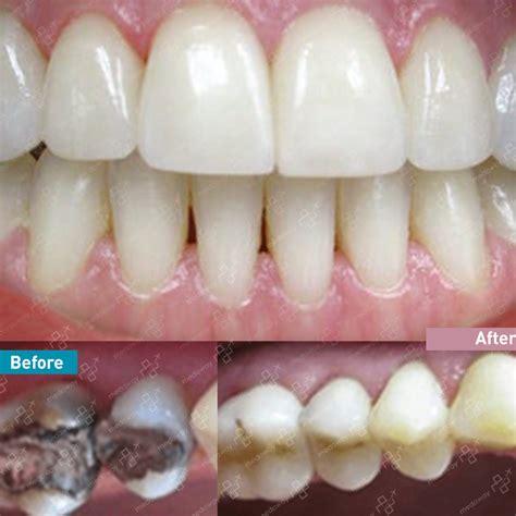 Dental Implants Turkey - Individual, Full Mouth & All on 4 | MedAway