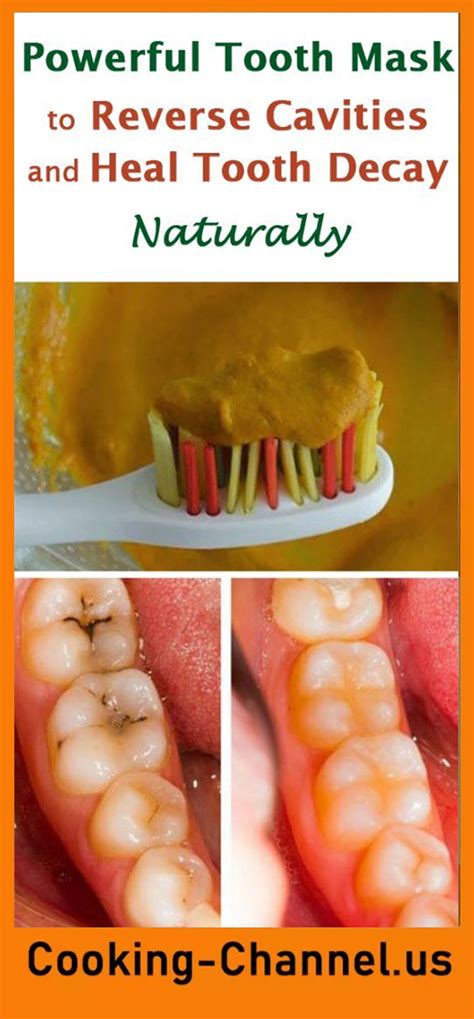 How to Heal a Cavity Naturally – 5 Methods Recipes – Page 2 | Teeth health, Reverse cavities ...