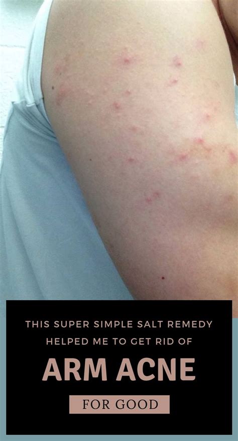 This Super Simple Salt Remedy Helped Me To Get Rid Of Arm Acne For Good - 101BeautyTips.org ...