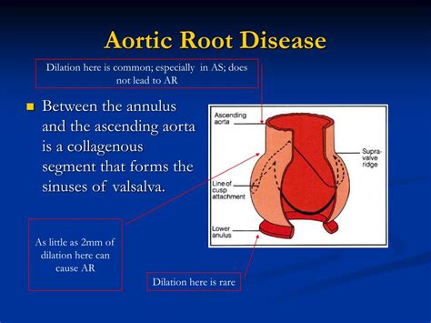 PPT - Aortic Regurgitation PowerPoint Presentation, free download - ID ...