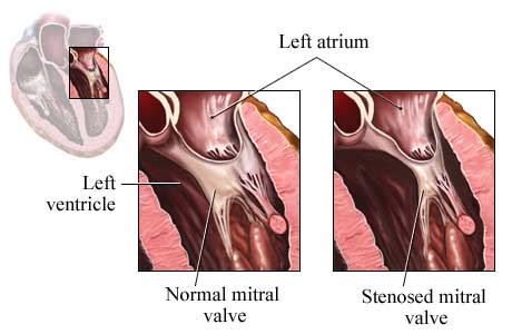 Mitral valve stenosis; Mitral Stenosis