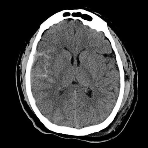 Axial noncontrast head CT scan, traumatic subarachnoid hemorrhage ...