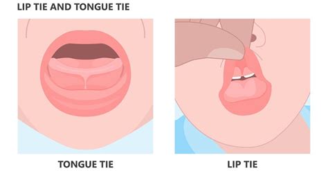 Tongue-Tie & Lip Tie Symptoms & Treatment | TherapyWorks