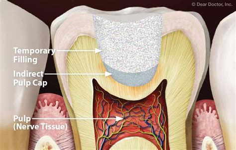 Indirect Pulp Capping - Atlas Dental