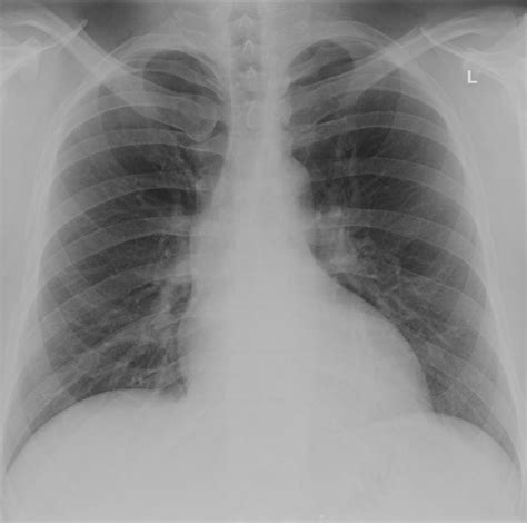 Cardiomegaly X Ray - tacitceiyrs