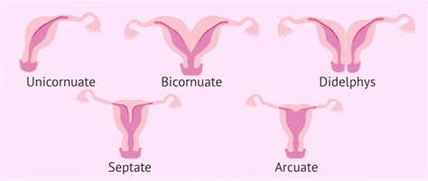 Müllerian Anomalies: Diagnosis and Management of Abnormal Uterine ...