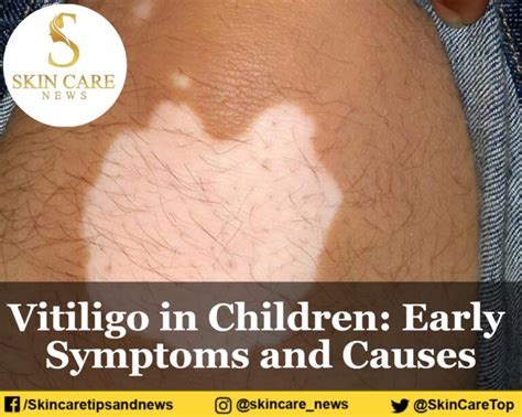 Vitiligo in Children: Early Symptoms and Causes