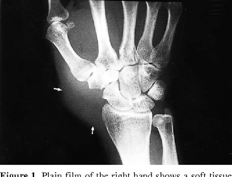 Figure 1 from Malignant Fibrous Histiocytoma of the Hand: MRI | Semantic Scholar