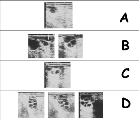 Ultrasound images of ovaries after ablation of follicles >5 mm in ...