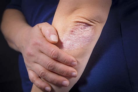 Here Are Four Easy Ways To Manage A Psoriasis Flare Up