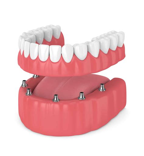 اوردنچر دندان چیست؟ قیمت اوردنچر دندان چقدر است؟ کلینیک ژنیک