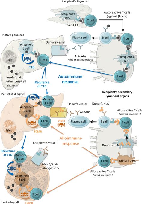 Pathophysiology of type 1 diabetes, autoimmune recurrence and allograft ...