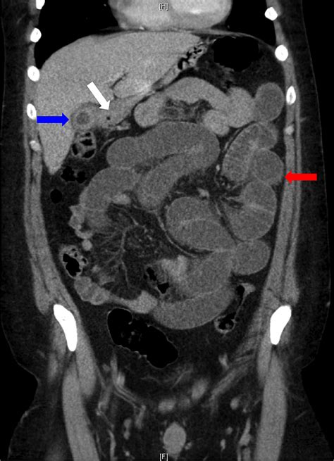 Cureus | Gallstone Ileus: An Unusual Cause of Intestinal Obstruction