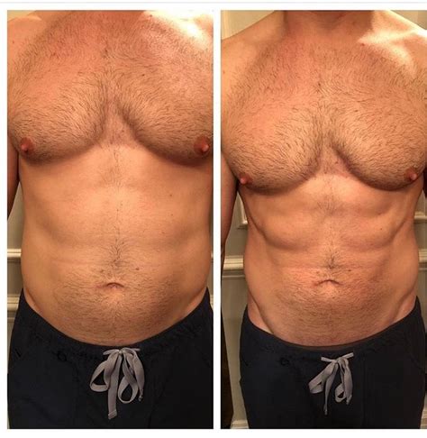 CoolSculpting for men in NYC - Just Melt Med Spa