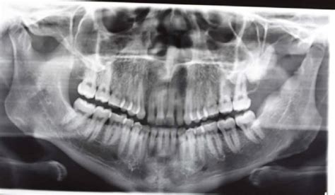 Post-operative orthopantomogram. | Download Scientific Diagram