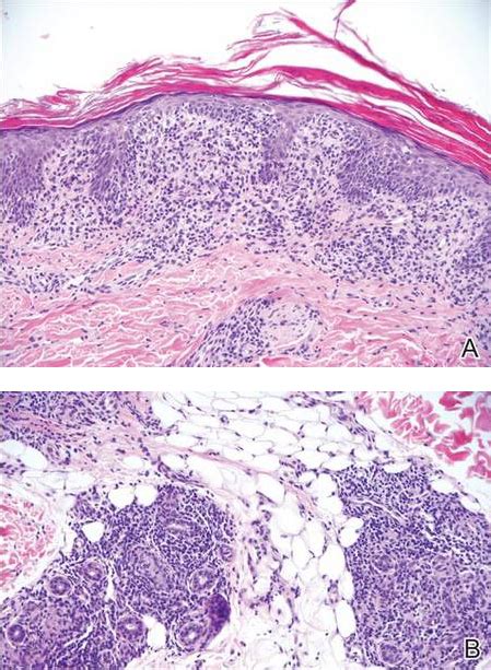 Lichen Striatus | MDedge Dermatology