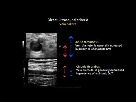 Acute and chronic Deep vein thrombosis Vein diameter variation - YouTube