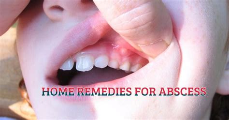 How To Drain A Gum Abscess At Home Video