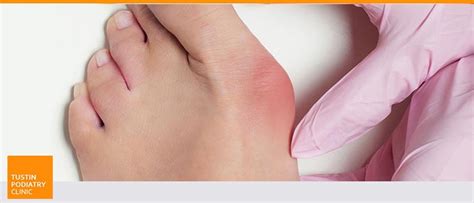 Foot Deformity Treatment in Tustin CA | Dr. Charles Baik DPM