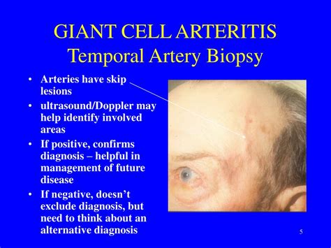 PPT - GIANT CELL ARTERITIS (Temporal or Cranial Arteritis) PowerPoint ...