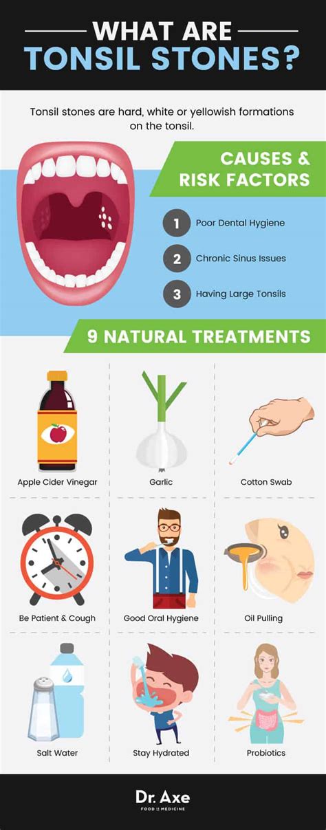 Tonsil Stones Causes, Symptoms and Treatment Options - Dr. Axe