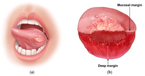 Cancers | Free Full-Text | Surgical Extent for Oral Cancer: Emphasis on ...