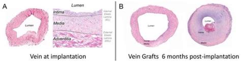 Vein Graft Histology: measurements conducted at the time of graft... | Download Scientific Diagram