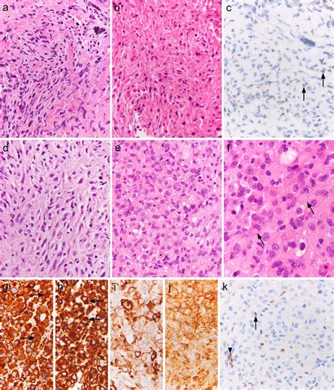 Histological findings for the tumor. Histological findings for the... | Download Scientific Diagram