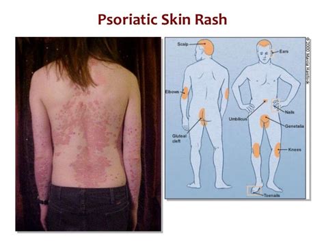 rheumatoid arthritis rash - pictures, photos